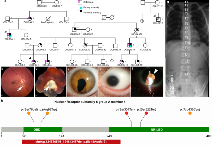 Variants in NR6A1 cause a novel oculo vertebral renal syndrome