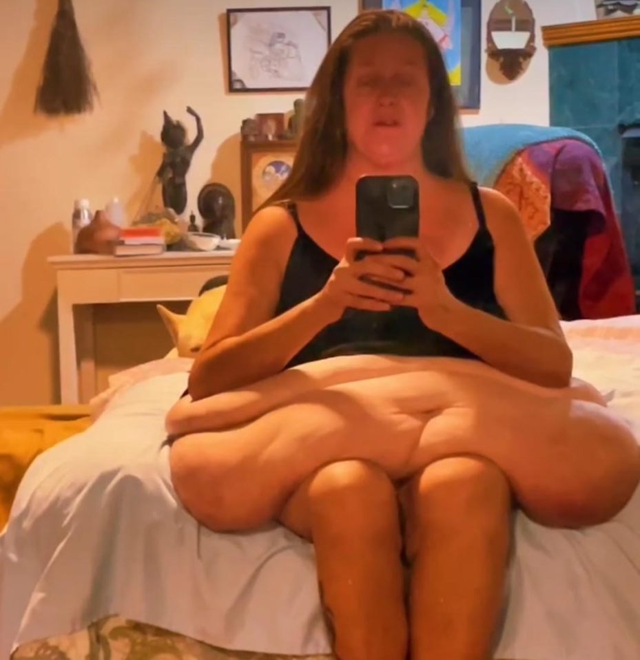 Woman with excess skin after weight loss, sitting on a bed and looking at her phone.