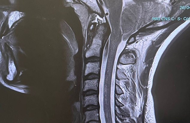 Arnold¿Chiari Malformation is a structural defect in the base of the skull and brain, where the cerebellum - the part that controls coordination and balance - extends into the spinal canal. (An example of the condition, shown in another patient's MRI scan, is seen here)