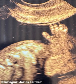 James also shared a photo of his partner's ultrasound photo, which showed their unborn baby's hand