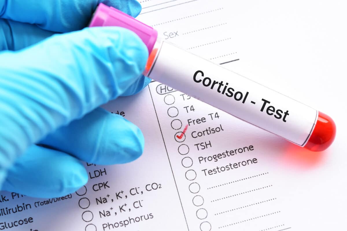 Cortisol blood test for stress levels