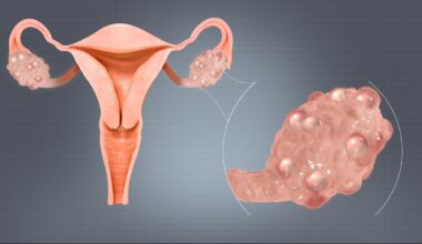 How genetic factors influence the onset and progression of Polycystic Ovary Syndrome