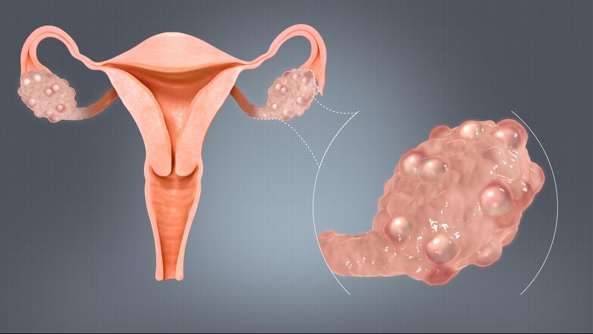 How genetic factors influence the onset and progression of Polycystic Ovary Syndrome