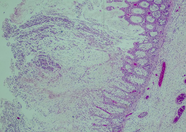 C. diff bacteria