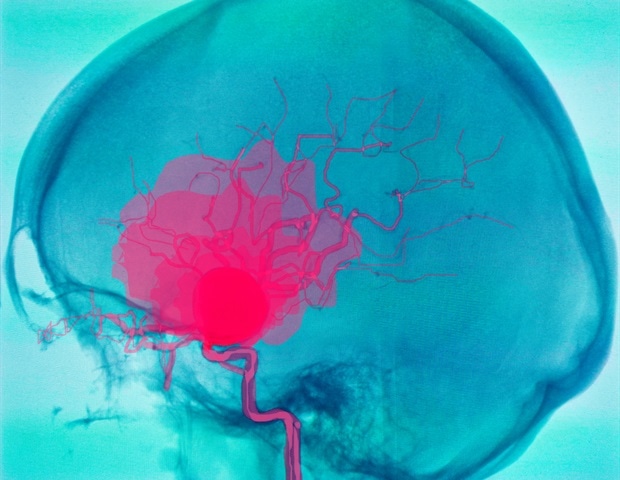 Exploring the genetic link between COPD and abdominal aortic aneurysm