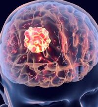 EU Grants Conditional Approval of Mirdametinib for NF1-Associated Plexiform Neurofibromas