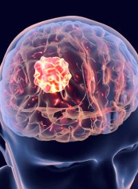 EU Grants Conditional Approval of Mirdametinib for NF1-Associated Plexiform Neurofibromas