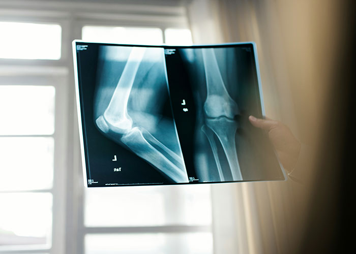 X-ray images of elbow bones held by a person, illustrating delayed patient help with shocking medical consequences.