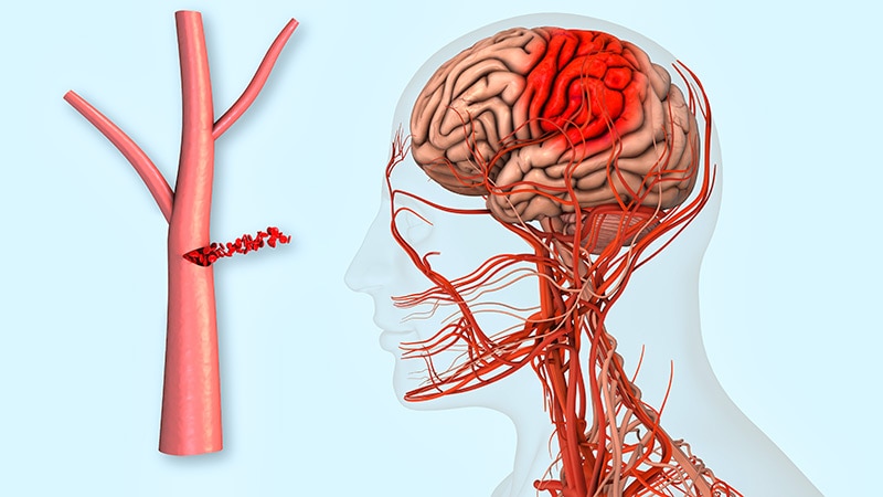 Anticoagulants in AF Post-ICH: The Dilemma Continues