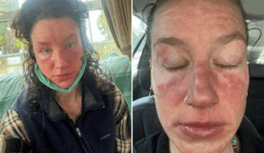 I thought it looked like I had survived a fire, then I learned about Topical Steroid Withdrawal