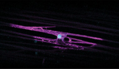Researchers identify gene implicated in disorders affecting millions