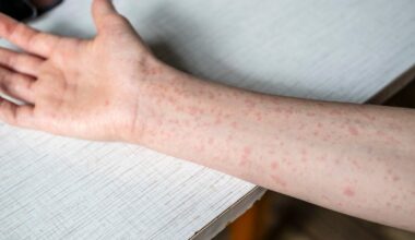 Measles cases in the U.S. hit the highest total recorded in more than 30 years