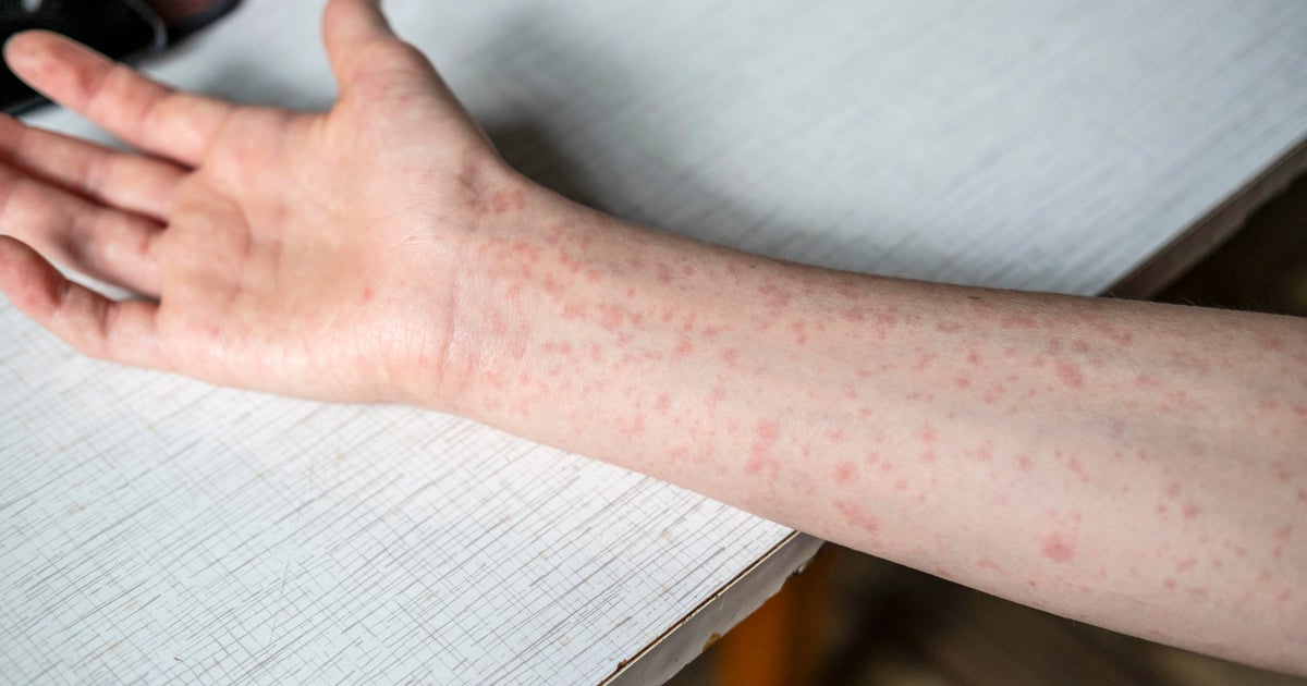 Measles cases in the U.S. hit the highest total recorded in more than 30 years