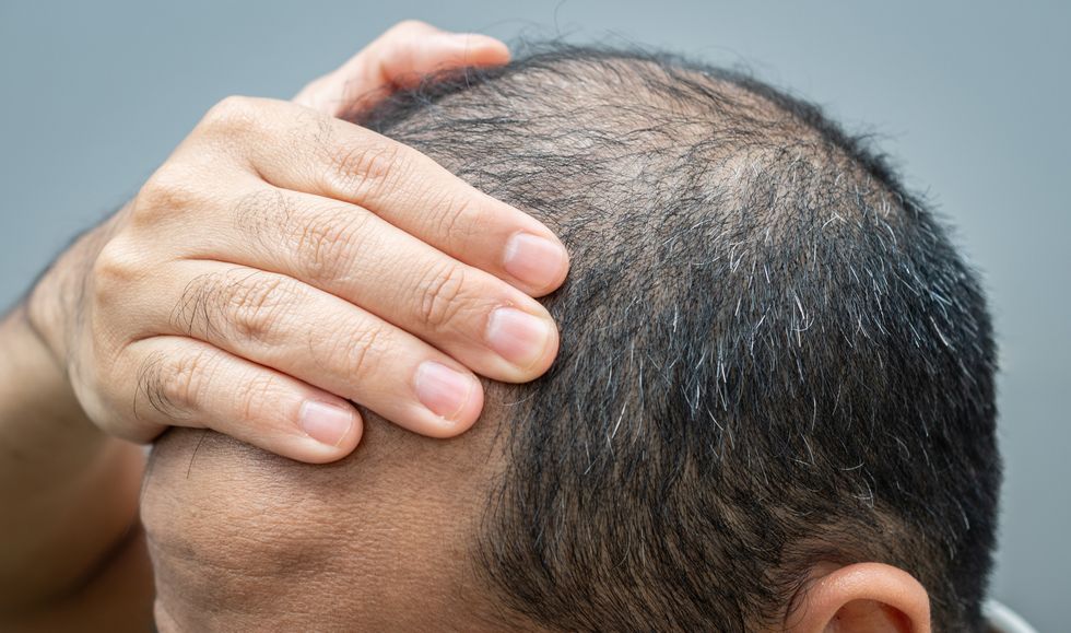 HAIR LOSS MALE