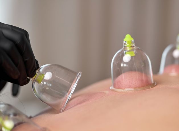Everyone’s talking about: Cupping therapy – what are those dark red circles and are there any health benefits?