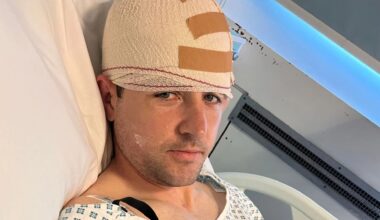 My brain FLIPPED in my skull as my head smashed against the road when a drunk driver ploughed into me then ran off