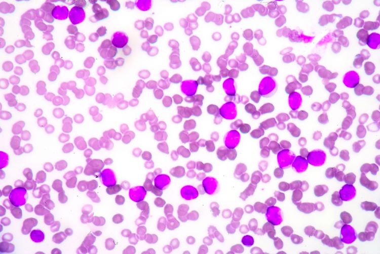 Phase I trial illustrates safer stem cell transplant for genetic disease