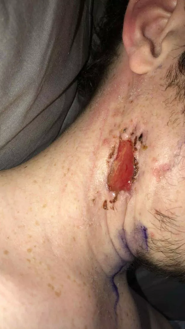 Open septic wound