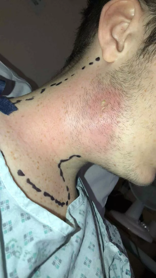 Abscess