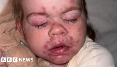 Children offered chickenpox vaccine on NHS