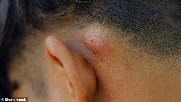 In addition to causing painful lumps and swellings, Staph can lead to more serious conditions such as blood poisoning and toxic shock syndrome