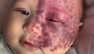 Brooke Atkins, 36, from the Gold Coast , Queensland , gave birth to her second child, Kingsley, in 2022, and immediately noticed he'd been born with a large Port Wine Stain (PWS) birthmark covering half of his face. Kingsley pictured at the time of his birth