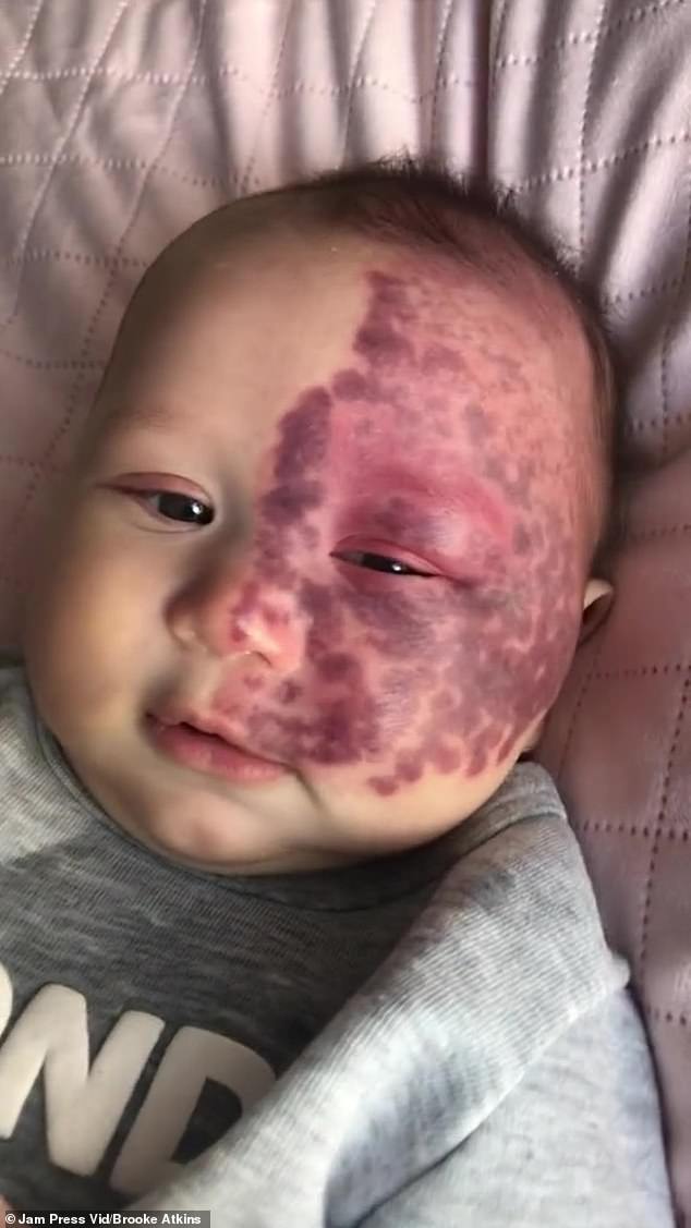 Brooke Atkins, 36, from the Gold Coast , Queensland , gave birth to her second child, Kingsley, in 2022, and immediately noticed he'd been born with a large Port Wine Stain (PWS) birthmark covering half of his face. Kingsley pictured at the time of his birth
