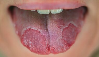 Geographic tongue, where the central part goes red and the outer edges turn white and yellow, making it look like a map, is more common in people with eczema and psoriasis