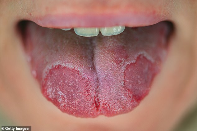 Geographic tongue, where the central part goes red and the outer edges turn white and yellow, making it look like a map, is more common in people with eczema and psoriasis