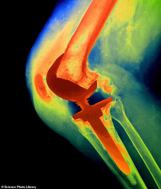 More than 100,000 people a year have knee replacement surgery on the NHS due to osteoarthritis – where shock-absorbing cartilage inside the joint gets eroded through a process of inflammation and wear and tear