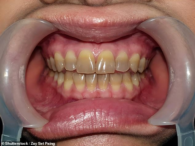 Stripes of blue or grey in the teeth can be attributed to antibiotics taken as a youngster (stock image)