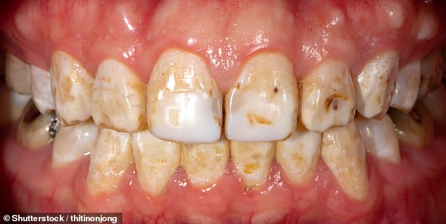 Brown streaks can be caused by severe fluorosis ¿ a condition triggered by excessive fluoride intake during tooth development (stock image)