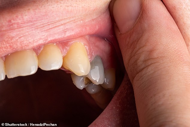 A grey tooth (pictured) can indicate it has 'died' from trauma. If a tooth is dark black, however, it could be a sign of advanced decay (stock image)