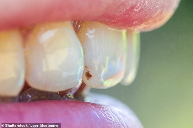 Brown spots on your teeth ¿ apart from being unsightly ¿ can also be early warning signs of tooth decay (stock image)