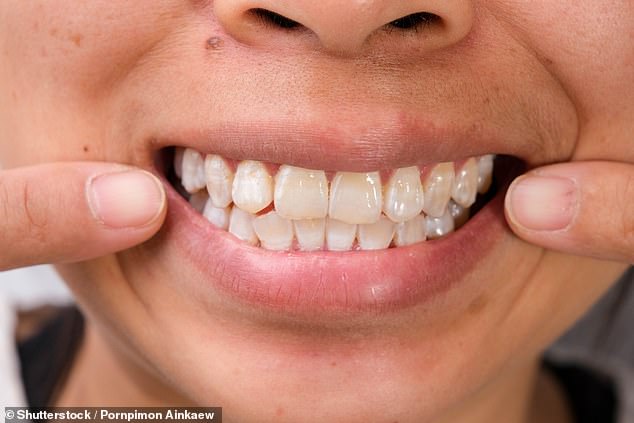 While most people want their teeth to be as white as possible, chalky white spots can mark early decay (stock image)