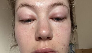 Ellen Swarbrick, from Wilmslow, Cheshire, started waking up with a 'puffy' face in spring 2022, but had always assumed it was just the result of hay fever