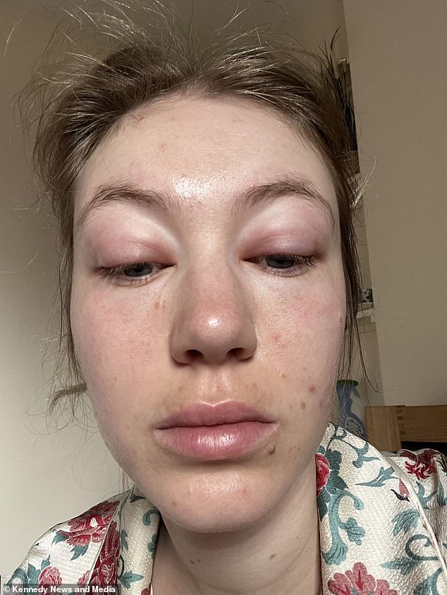 Ellen Swarbrick, from Wilmslow, Cheshire, started waking up with a 'puffy' face in spring 2022, but had always assumed it was just the result of hay fever