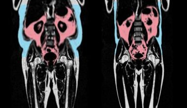 Two MRI scans showing a person (left) with more visceral fat (in red) and subcutaeous fat (in blue)