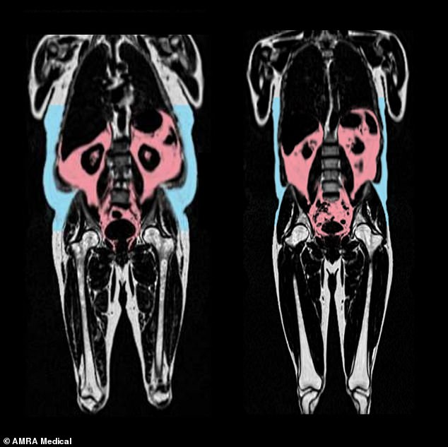 Two MRI scans showing a person (left) with more visceral fat (in red) and subcutaeous fat (in blue)
