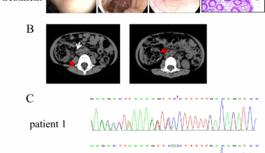 Clinical features and genetic analysis of A20 haploinsufficiency | Orphanet Journal of Rare Diseases