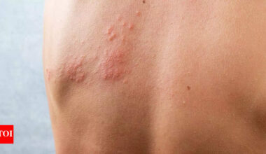 Best home remedies to soothe herpes skin rashes naturally |