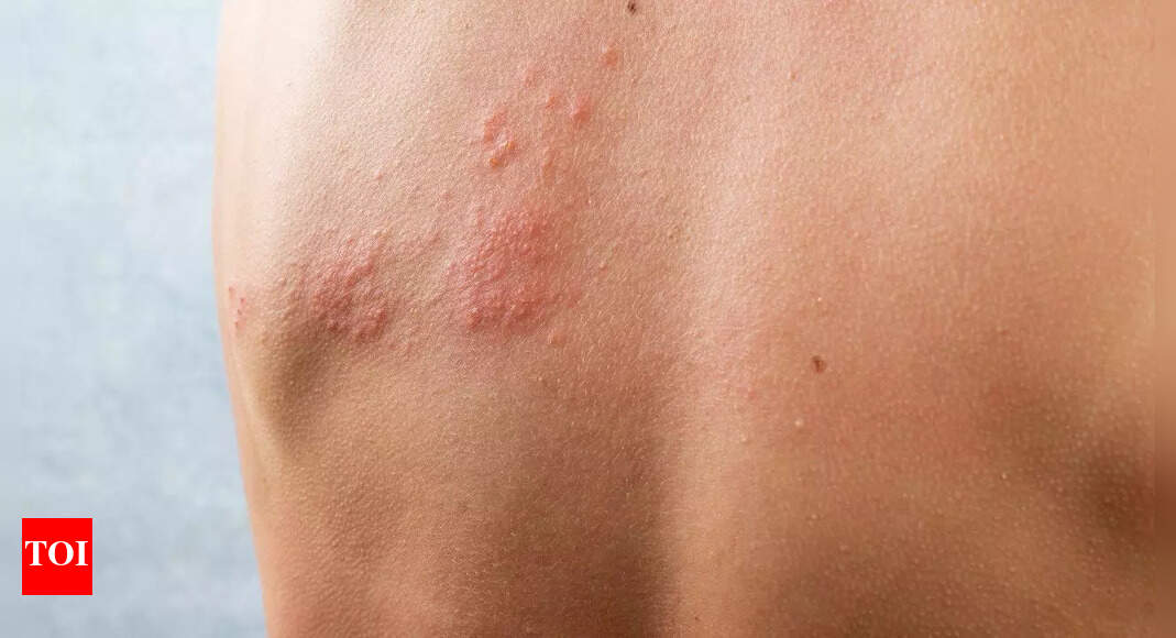 Best home remedies to soothe herpes skin rashes naturally |