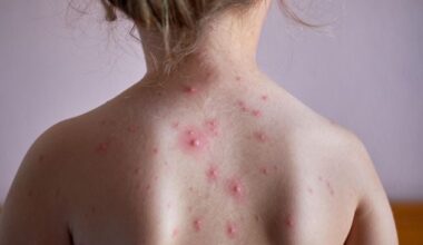 Children in NI to be offered chickenpox vaccine