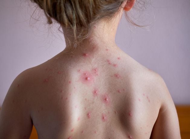 Children in NI to be offered chickenpox vaccine