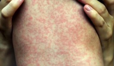 West Midlands parents urged to ensure children have MMR jab