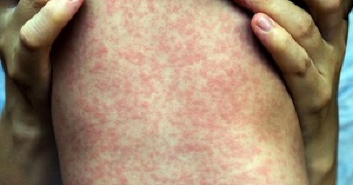 West Midlands parents urged to ensure children have MMR jab