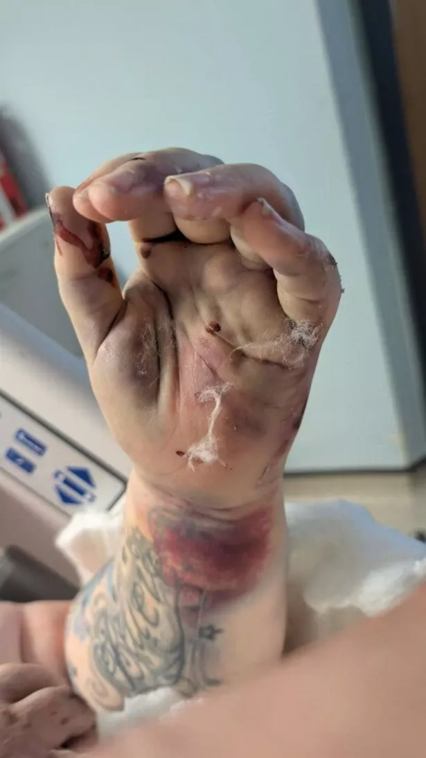 Louise also suffered multiple fractures and ligament damage