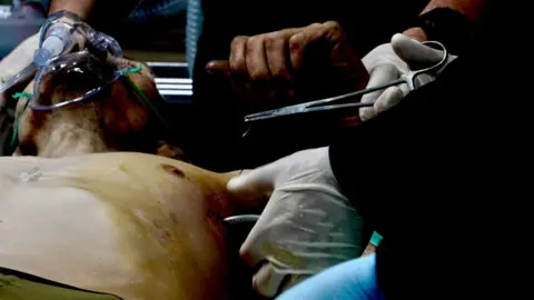 BBC News A man is lying topless, wearing a breathing mask, as a pair of hands holding pliers appears to stitch up a wound under his armpit