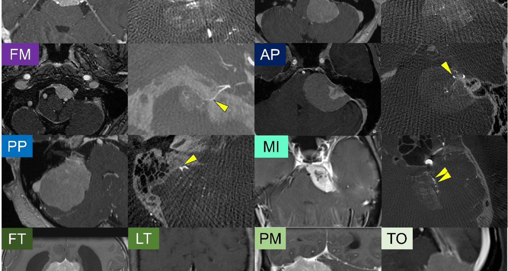 Integrated molecular and detailed anatomical profiling identifies a prognostically adverse subtype of posterior fossa meningiomas: high-risk copy number alterations are associated with midline predilection and predict poor prognosis | Acta Neuropathologica Communications