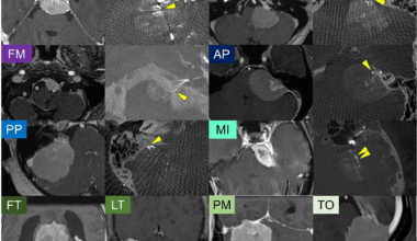 Integrated molecular and detailed anatomical profiling identifies a prognostically adverse subtype of posterior fossa meningiomas: high-risk copy number alterations are associated with midline predilection and predict poor prognosis | Acta Neuropathologica Communications